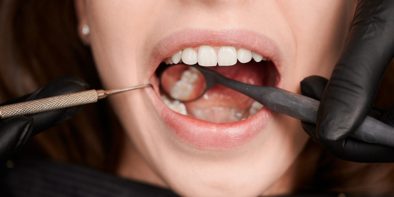 Tooth Extraction: When Saving the Tooth Is No Longer Possible
